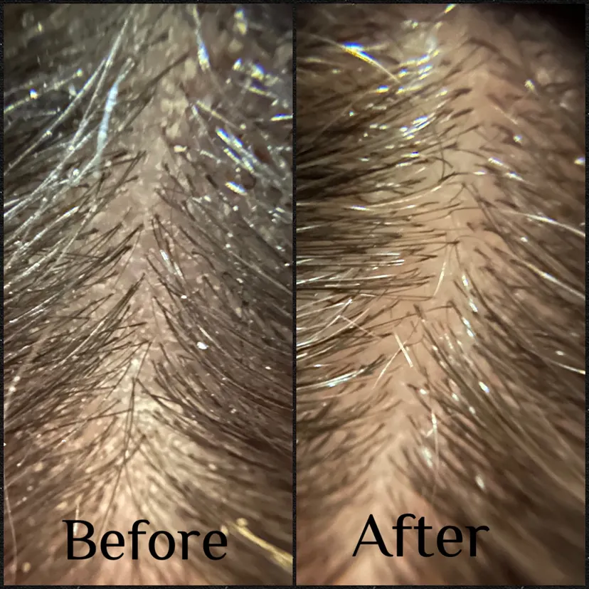 Root line buildup cleared before and after one Hair Play Method service